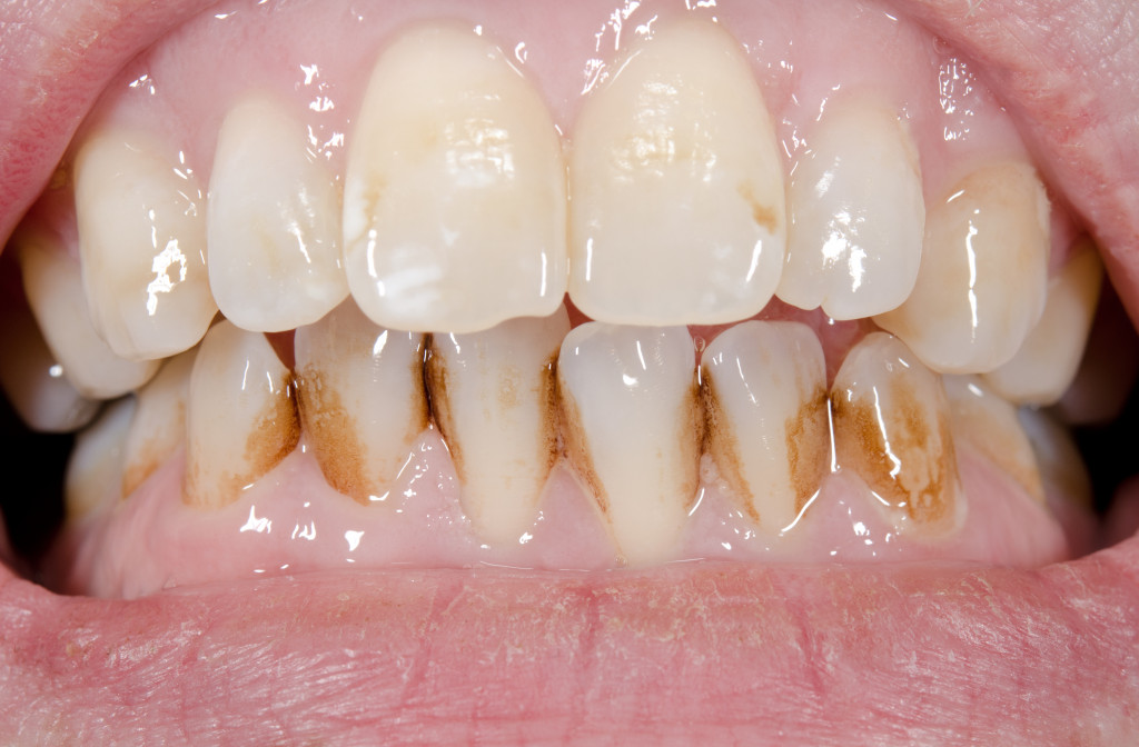 discolored-teeth